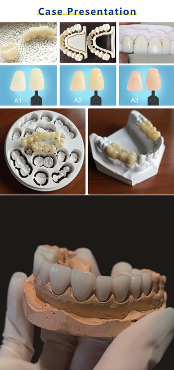 Anterior Restoration Cad Cam Dental Lab Use Ceramic Preshaded St Ht Zirconia Block For Teeth Crowns case presentation Anterior Restoration Cad Cam Dental Lab Use Ceramic Preshaded St Ht Zirconia Block For Teeth Crowns case presentation